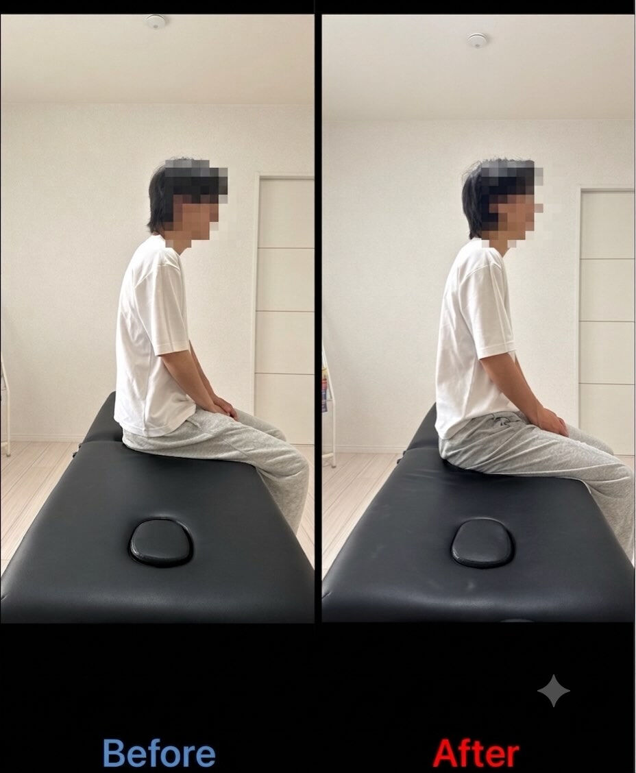 姿勢改善ビフォーアフターの紹介